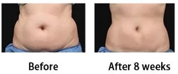 stomach after one fat freezing treatment