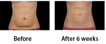 stomach after one fat freezing treatment