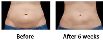 stomach after one fat freezing treatment