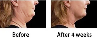 chin after one fat freezing treatment