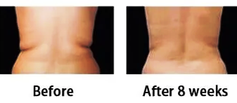 love handles after one fat freezing treatment